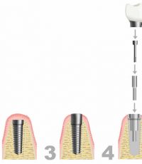 implant28 - مراحل ایمپلنت دندان - implant procedures