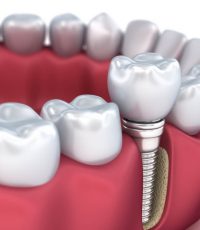 امروزه مزایای ایمپلنت دندان آن را تبدیل به جایگزینی بهتر برای دندان از دست رفته کرده است.