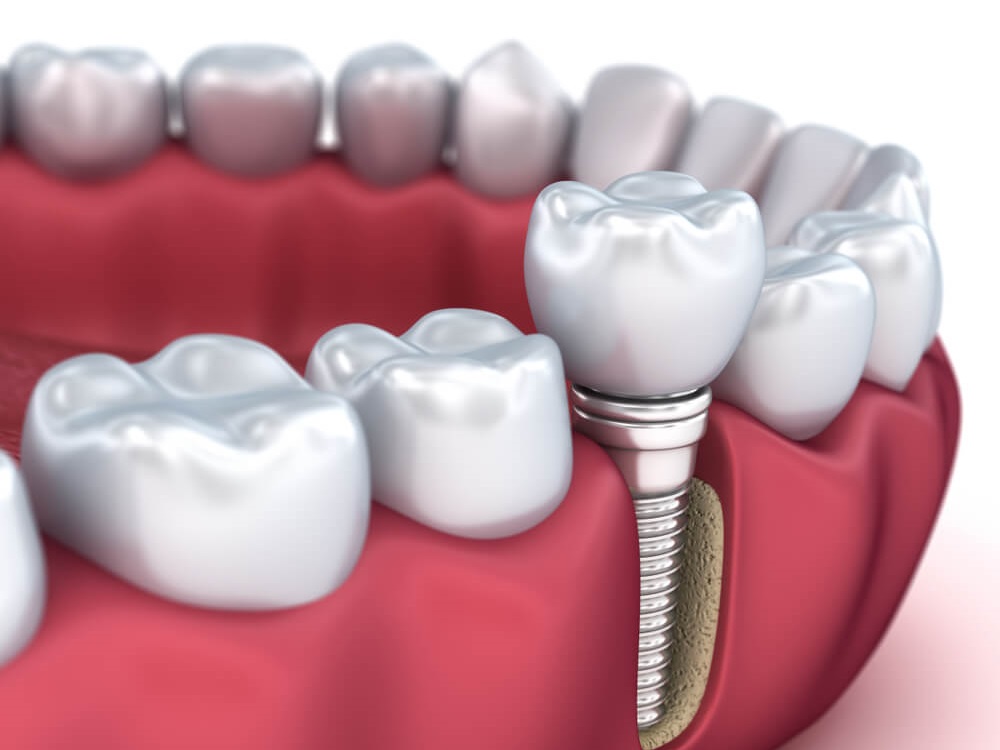 امروزه مزایای ایمپلنت دندان آن را تبدیل به جایگزینی بهتر برای دندان از دست رفته کرده است.