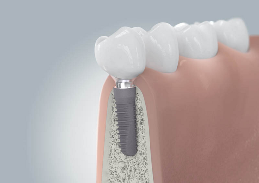 مزایای ایمپلنت دندان از فواید سایر روش های جایگزینی دندان بیشتر است