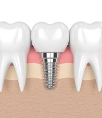 ایمپلنت دندان برای پشتیبانی از یک یا چند دندان آسیب دیده استفاده می‌شود