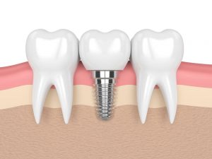 ایمپلنت دندان برای پشتیبانی از یک یا چند دندان آسیب دیده استفاده می‌شود